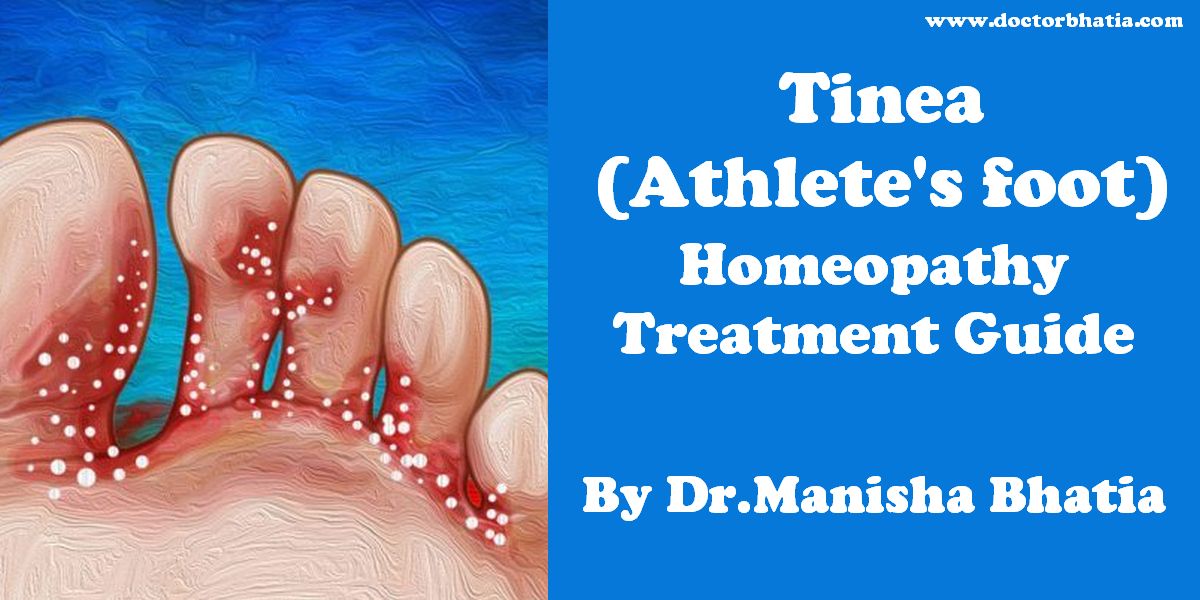 Understanding Tinea Corporis and Its Homeopathic Treatment - Homeo