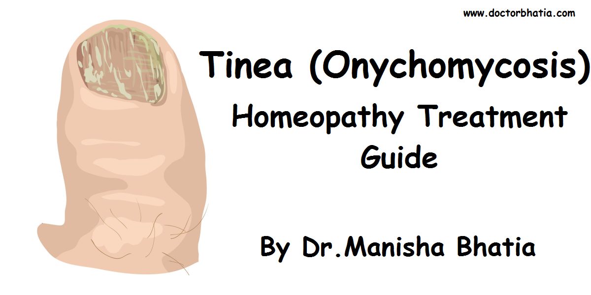 Tinea (Onychomycosis) - Homeopathy Treatment and Homeopathic