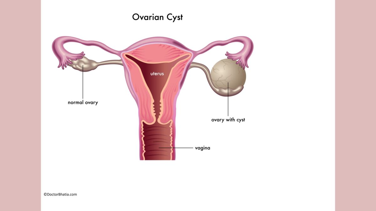 Effective Homeopathic Medicine For Ovarian Cyst Doctor Bhatias Asha Homeopathy 