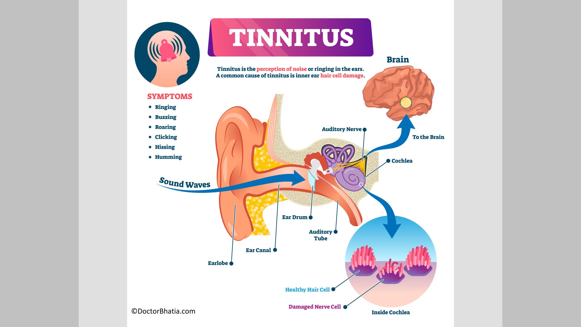 Pulsatile Tinnitus: Interventional Neuroradiologists Offer Answers & Relief