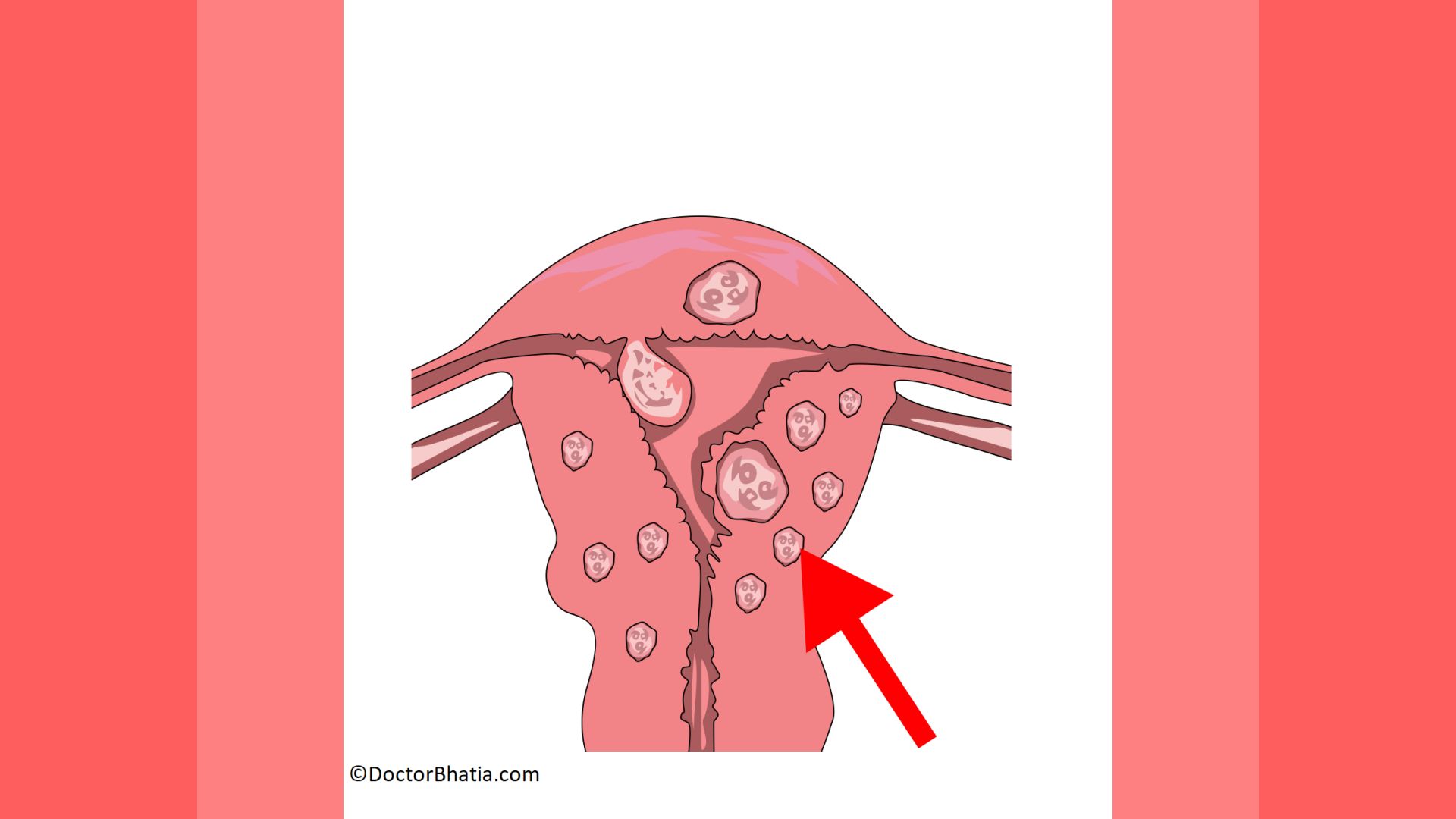 Menorrhagia and abnormal bleeding before the menopause - ScienceDirect